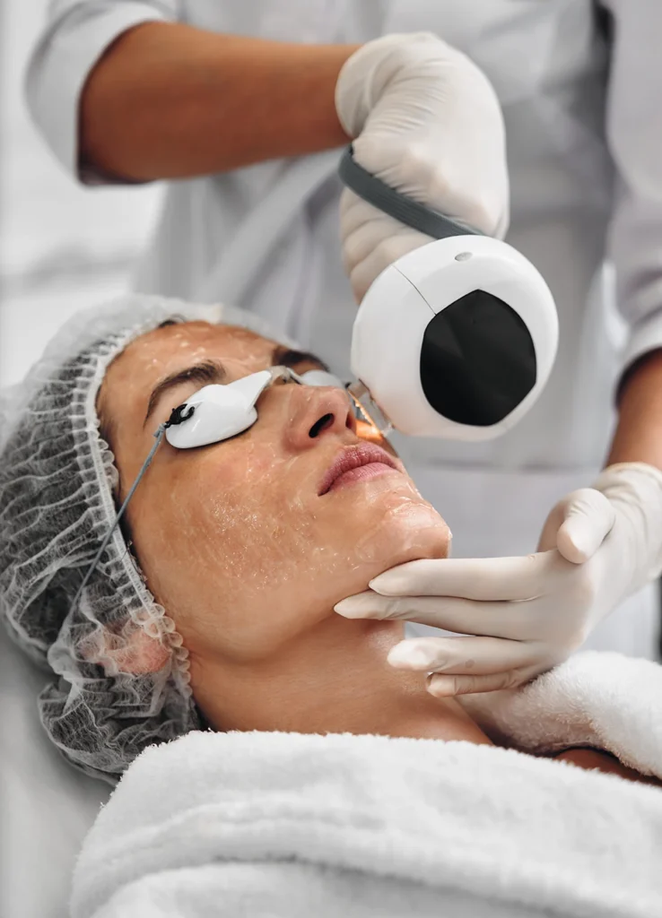 Laser para Manchas da Pele | Pele Uniforme e Saudável 1 tratamento a laser para manchas Antes e depois do tratamento a laser para manchas na Clínica Dra. Juliana Beani
Aplicação de laser para clareamento de manchas na pele