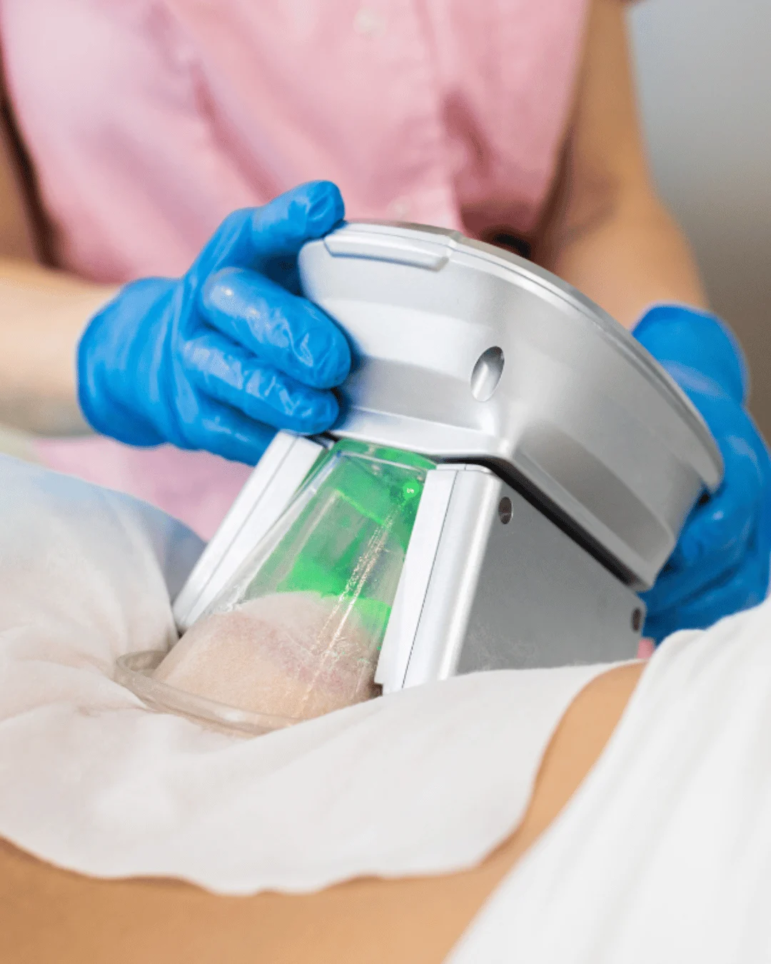 Sessão de Criomodelagem​ criolipolise e criusculpt dra juliana beani jundiai sp