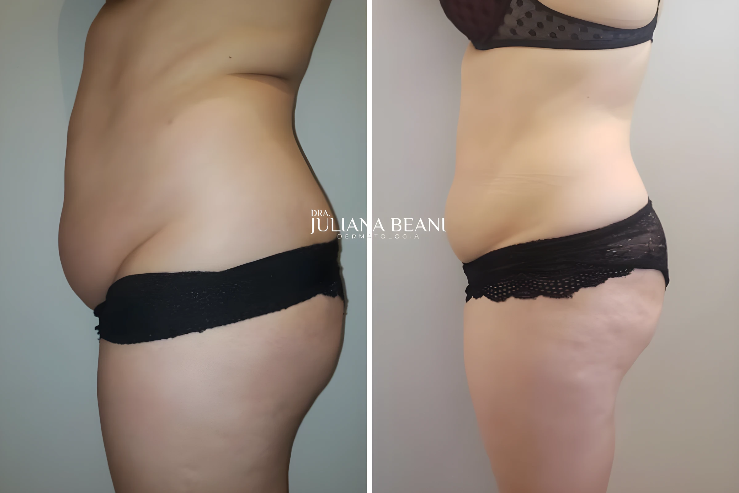 resultados de criolipolise criusculpt em jundiai