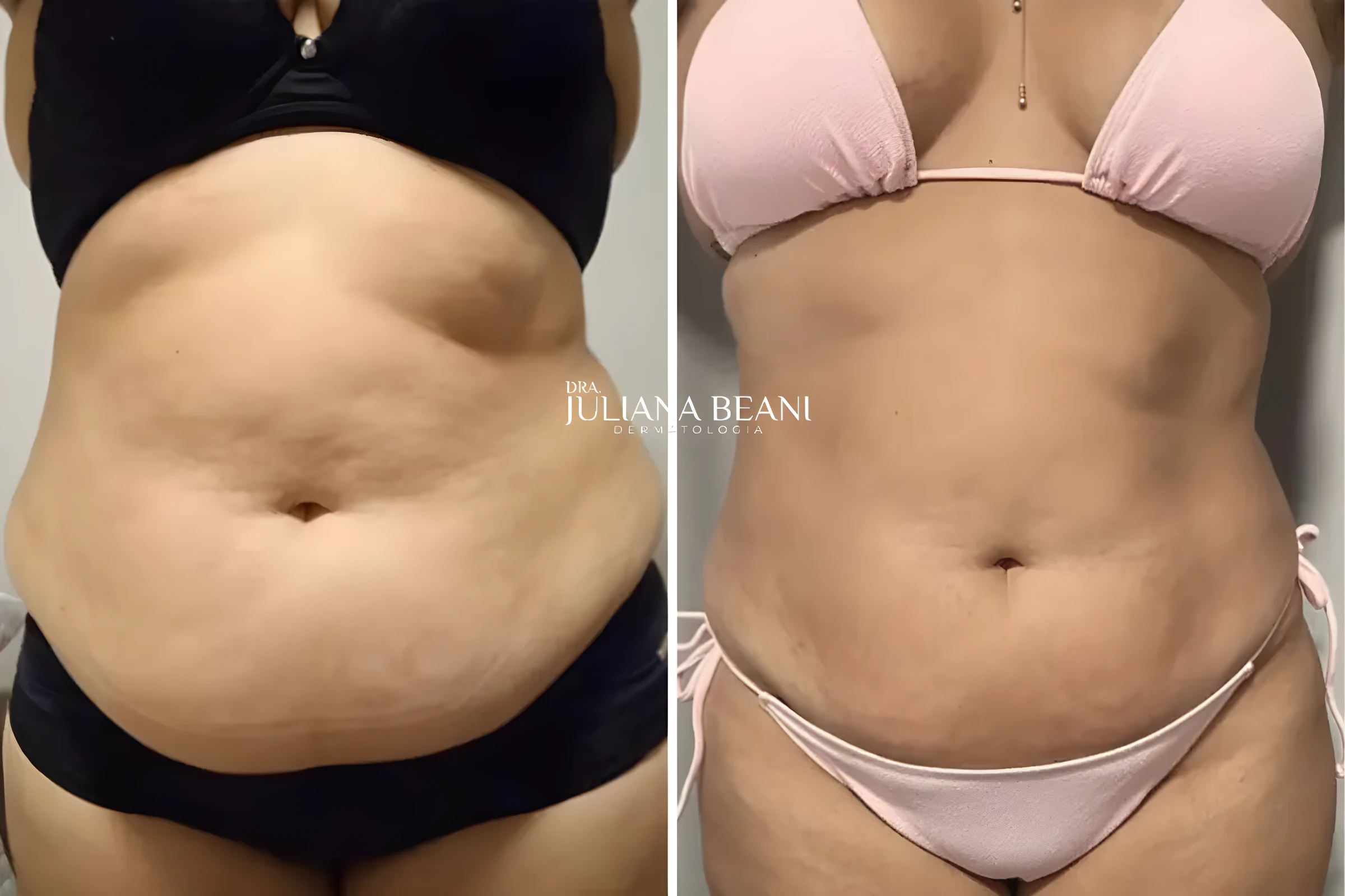 resultados de criolipolise criusculpt em jundiai