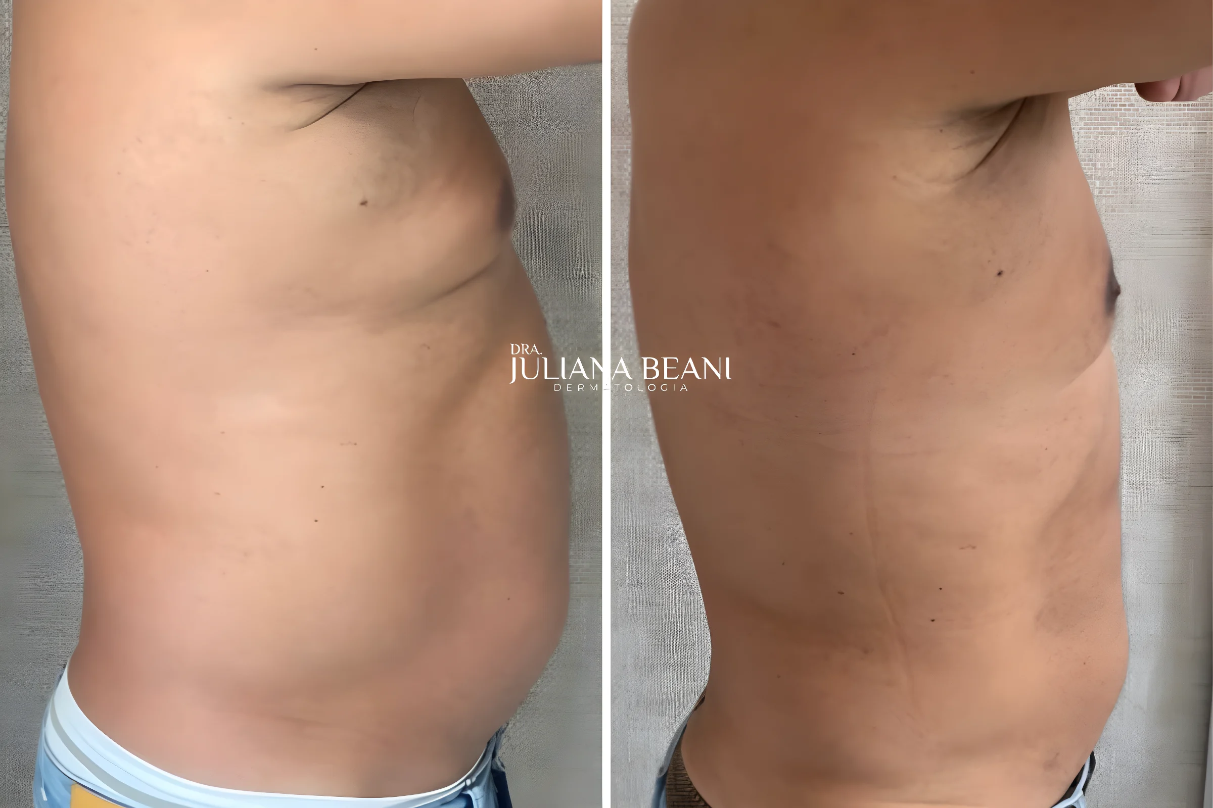 resultados de criolipolise criusculpt em jundiai