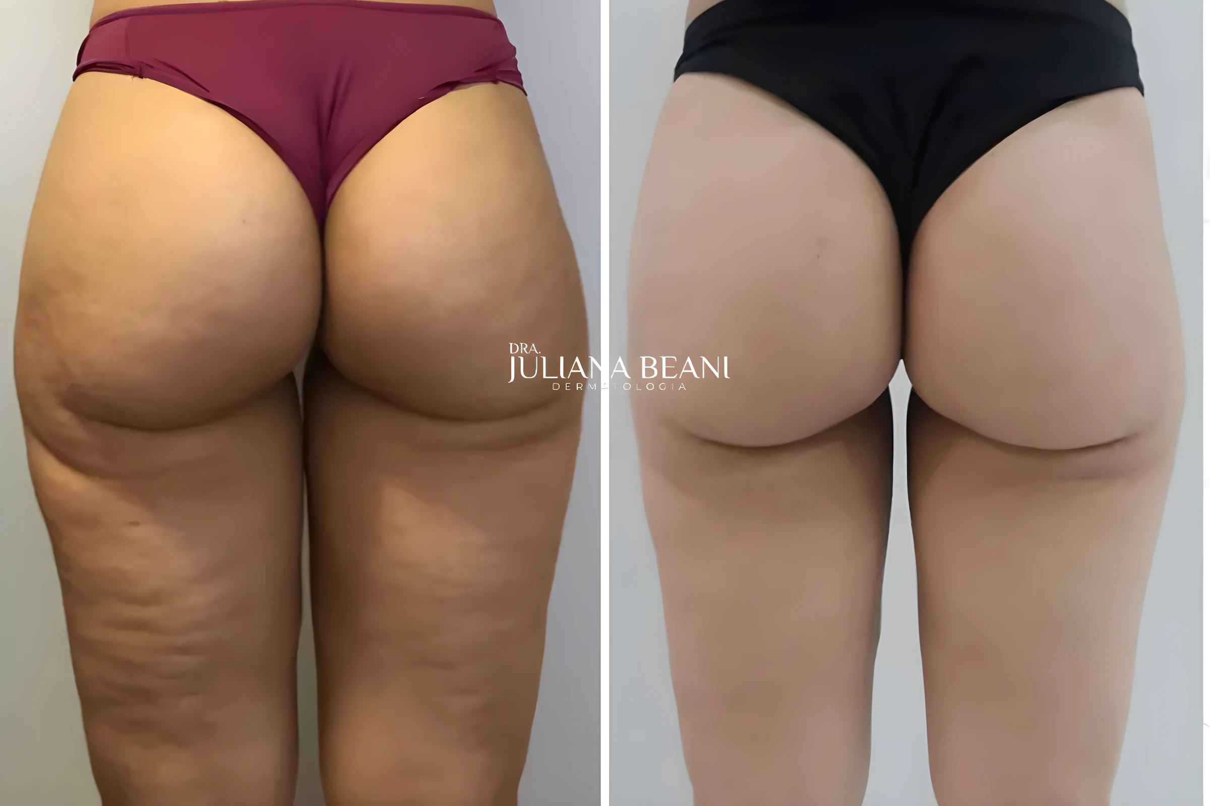 resultados de criolipolise criusculpt em jundiai