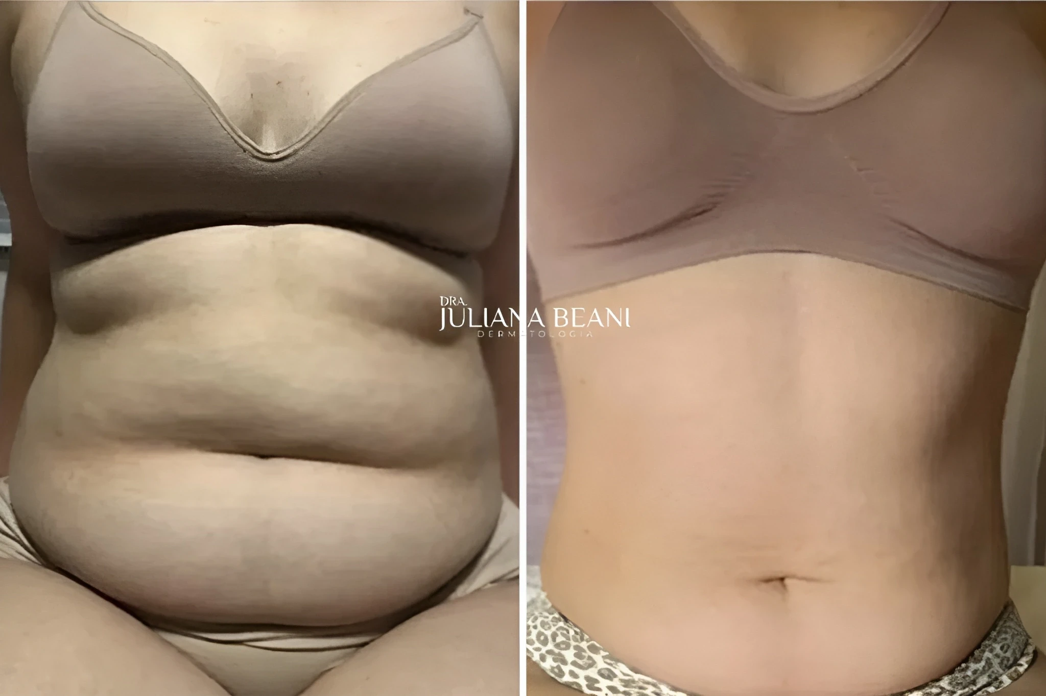 resultados de criolipolise criusculpt em jundiai