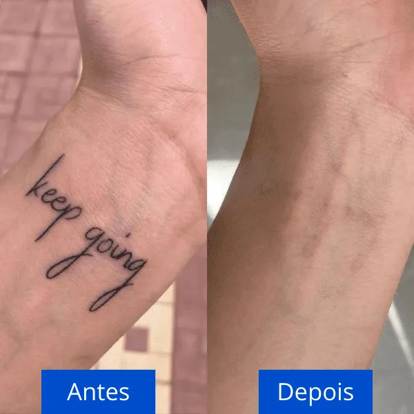 download 40 remoção de tatuagem