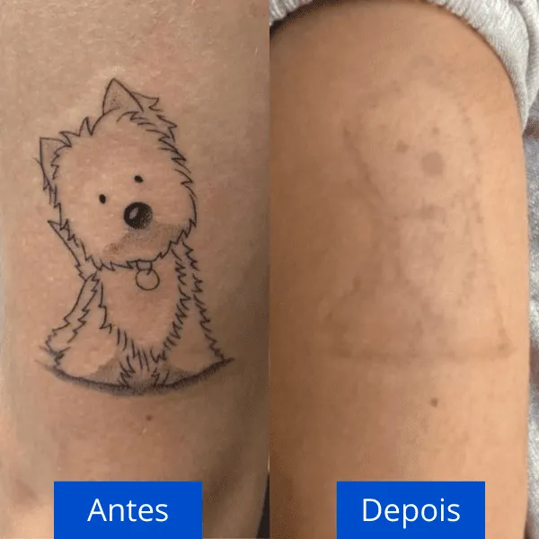 download 41 remoção de tatuagem