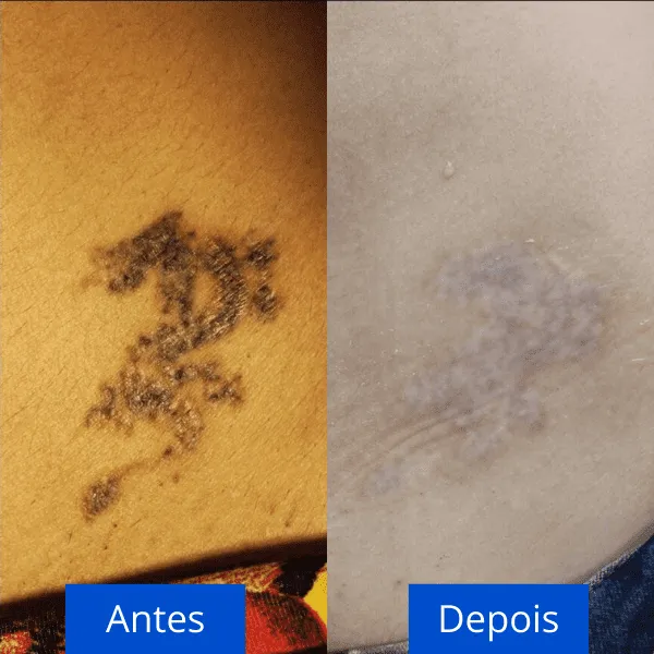 download 42 remoção de tatuagem