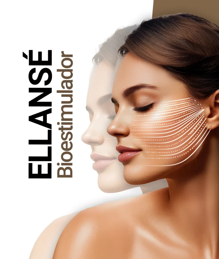 Ellanse - Bioestimulador com efeito preenchedor