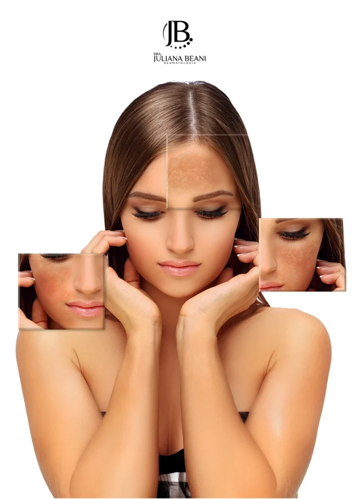 Dra. Juliana Beani, médica dermatologista, explicando sobre o Melasma