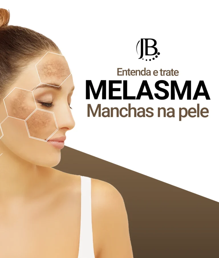 Melasma e manchas na pele